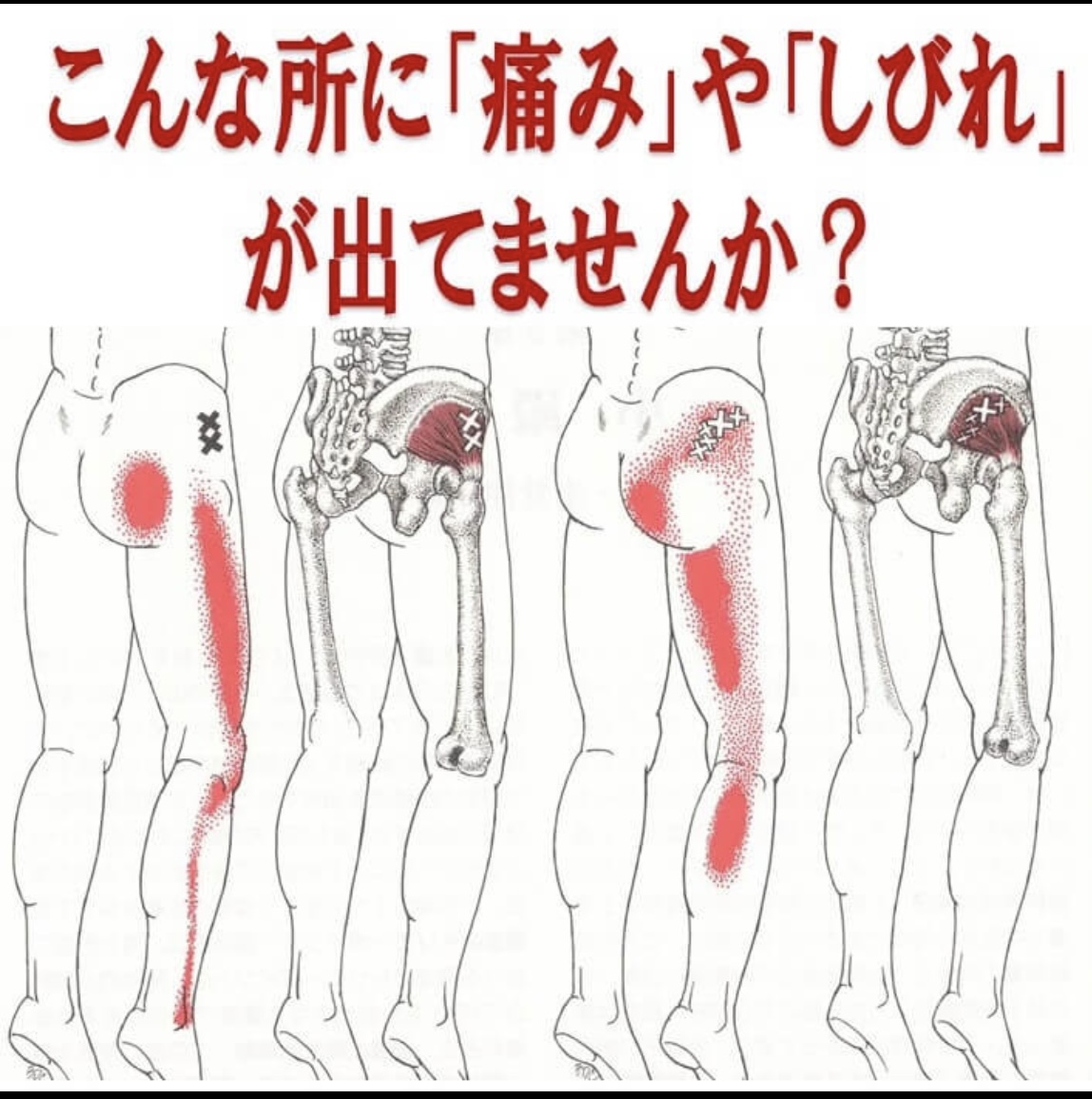 坐骨神経痛の痛みやしびれが出る場所の解説図